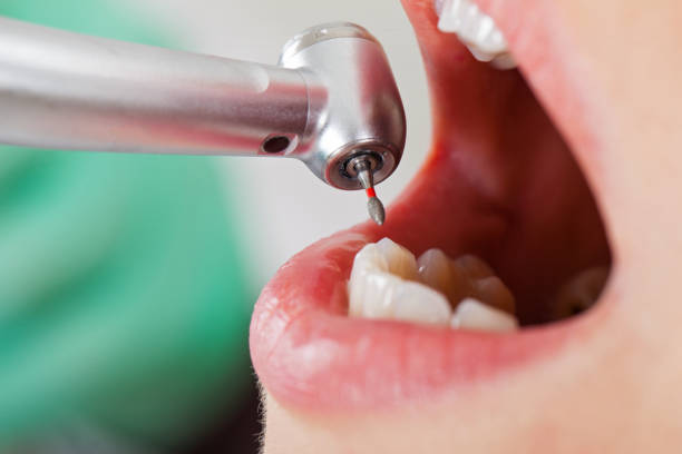 Best Lost Filling or Crown Replacement in Fremont, IN